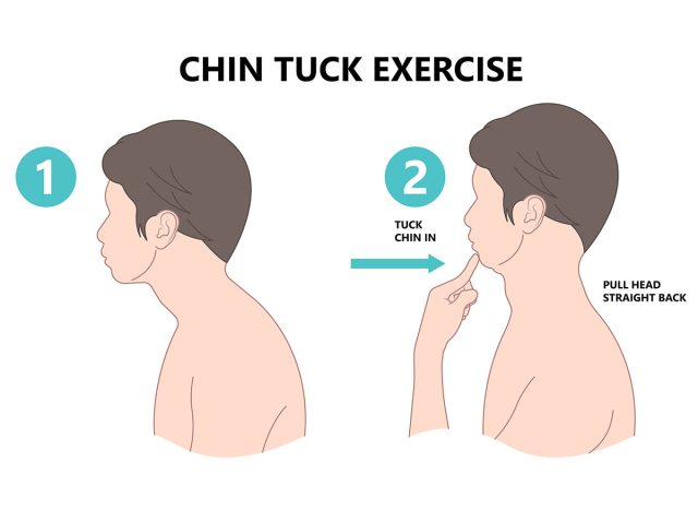 Chin Tuck κεφαλή κειμένου λαιμός ανύψωση πόνου νεύρο βαθιά κάμψη σπονδυλική στήλη φλεγμονή κακό σωστό φτωχό καλό τηλέφωνο έξυπνο δισκίο φορητό υπολογιστή χρήση από το σπίτι χειροπράκτη στέλεχος άνω πλάτη πίσω σαγόνι